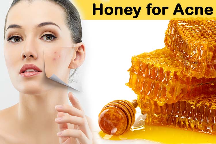 Honey treatment For Acne